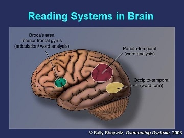 Brain - Overcoming Dyslexia